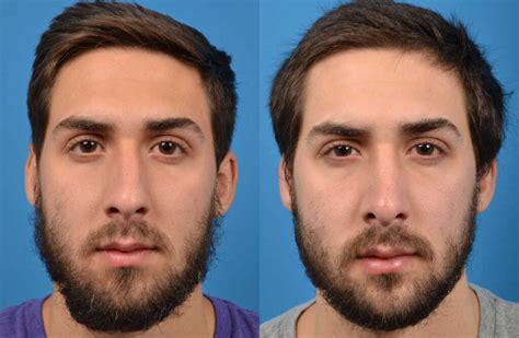 Rinoplastia En Hombres Todo Lo Que Debes Saber Nanova