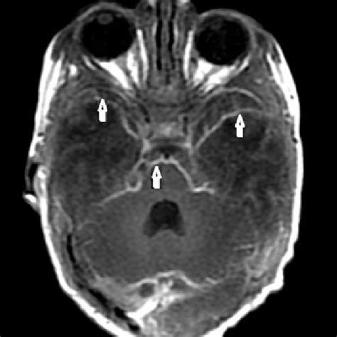 Axial Postcontrast T1 Weighted MR Image Shows Contrast Enhancement On