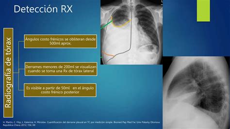 Derrame Pleural A Proposito De Un Caso Clinico Pptx Descarga Gratuita