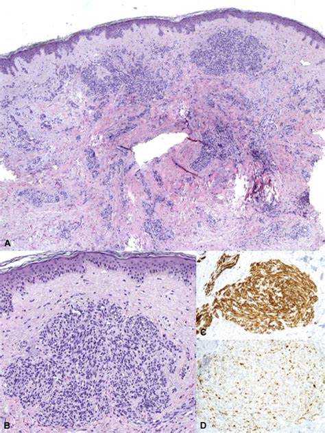 Dermoscopic Pattern Of Radiation Induced Angiosarcoma Ria Journal