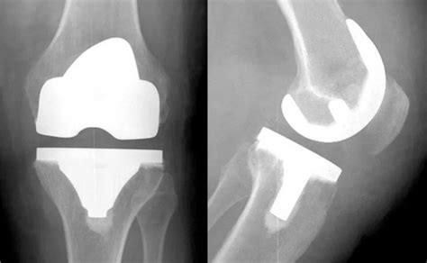 Cirurgia para artrose de joelho como é feita e quando é indicada