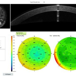 Anterior segment OCT pictures showing difference between group A and ...