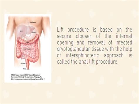 What Causes Anal Fissures Ppt
