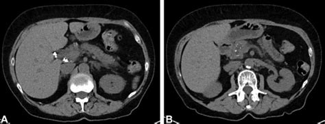 Pancreatoscopy Guided Laser Dissection And Ablation For Treatment Of Benign And Neoplastic