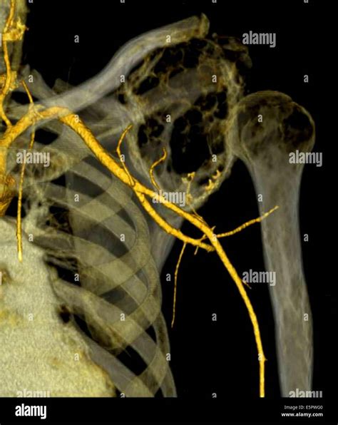 3D Computed Tomography CT Reconstruction Scan Of The Shoulder Stock