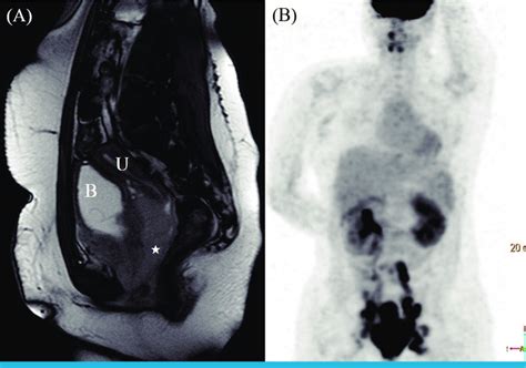Magnetic resonance imaging (A) and positron emission tomography (B ... 