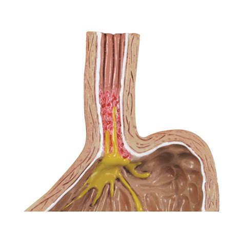 Modelo De Enfermedad Por Reflujo Gastroesofágico 2010 Gpi