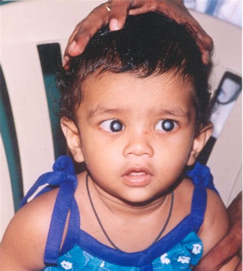 Childhood Cataracts Aravind Eye Care System