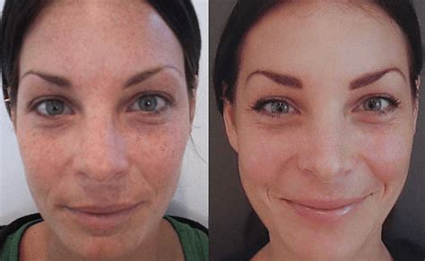 Chemical Peel Treatment Perfection Cosmetic