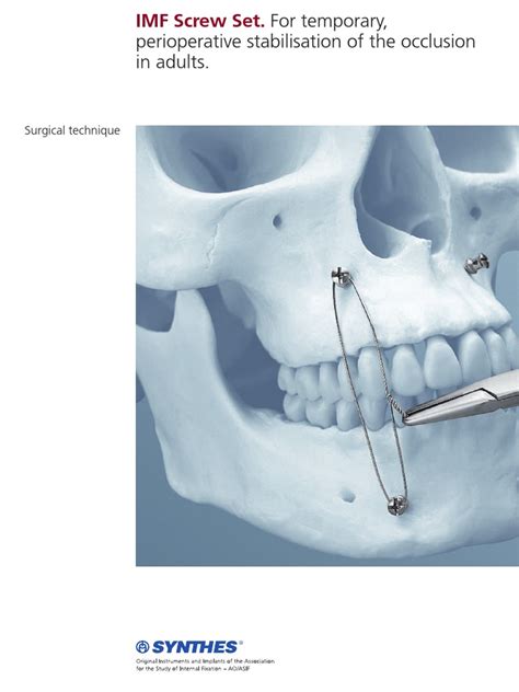 Imf Screw Set For Temporary Peri Operative Stabilisation Of The