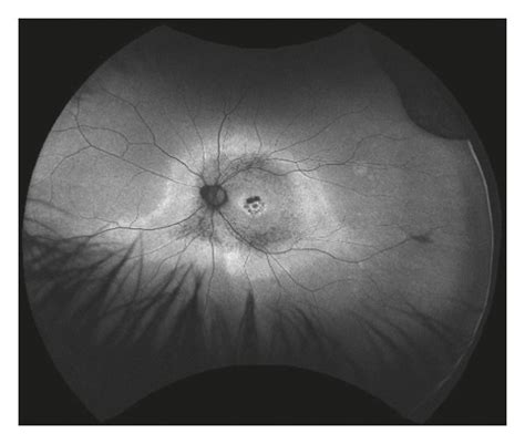 Ultra Wide Field Fundus Autofluorescence Uwf Faf A And B Images