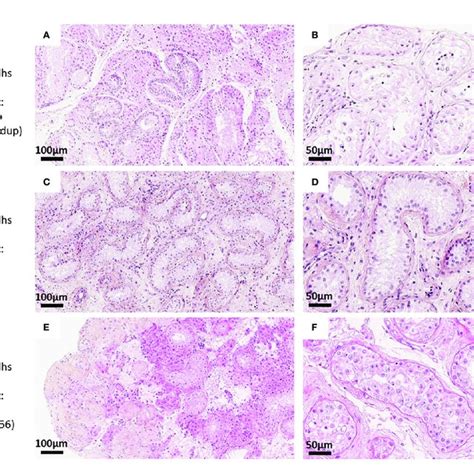 Histological Sections Of Testicular Biopsies Of Patient 1 A B