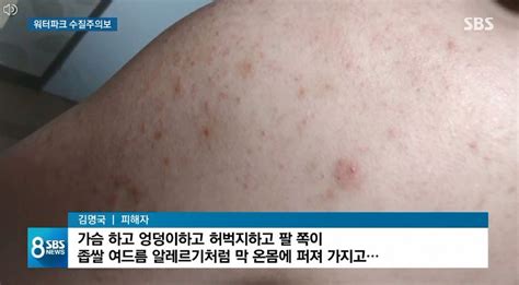 워터파크 수질 경악 수준가슴·엉덩이 등에 좁쌀 여드름 같은 두드러기 퍼져 이투데이