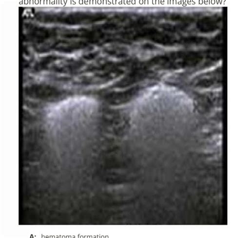 Breast Sonography Mock Registry Exam C Flashcards Quizlet