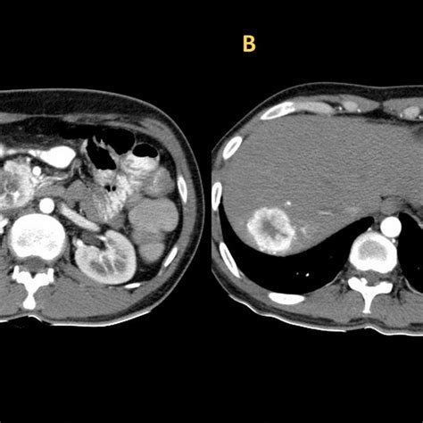 Axial Section Image Of Ct Scan Showing Heterogeneously Enhancing Mass Download Scientific