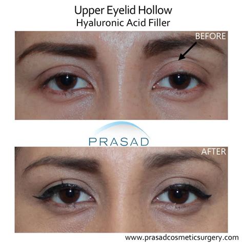 How To Fix Uneven Eyelids