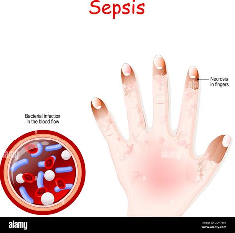 Sepsis Wallpaper