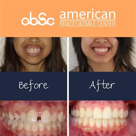 Before And After Braces Gaps