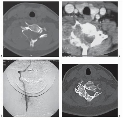 Benign Tumors Of The Cervical Spine Neupsy Key