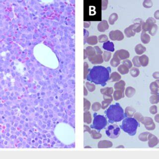 H E Stain Of Bone Marrow Core Biopsy A And Wright Giemsa Stain Bone