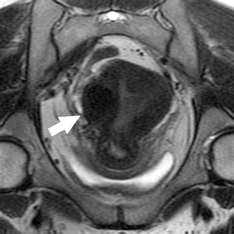 Increased Speed And Image Quality For Pelvic Single Shot Fast Spin Echo