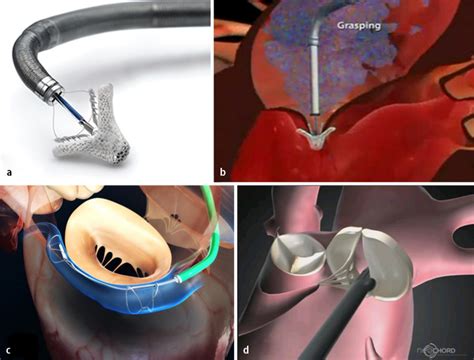 Interventionelle Therapie Von Herzklappenerkrankungen Springerlink