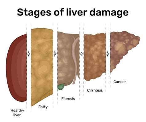 Signs Of Liver Damage How To Know If You Have Liver Damage