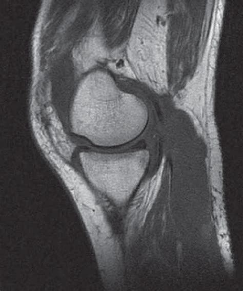 Contrast Enhanced Mri Of The Left Calf Sagittal Vue Bakers Cysts Download Scientific