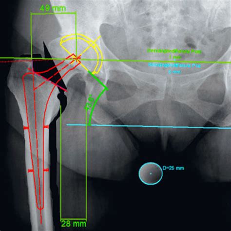 Orthopedic Software Medicad Hectec Gmbh Planning Preoperative Planning Hip