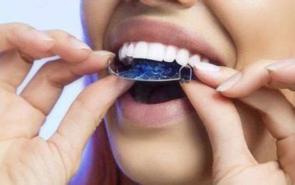 Retainers After Clear Aligners Treatment Sdalign Invisible Braces