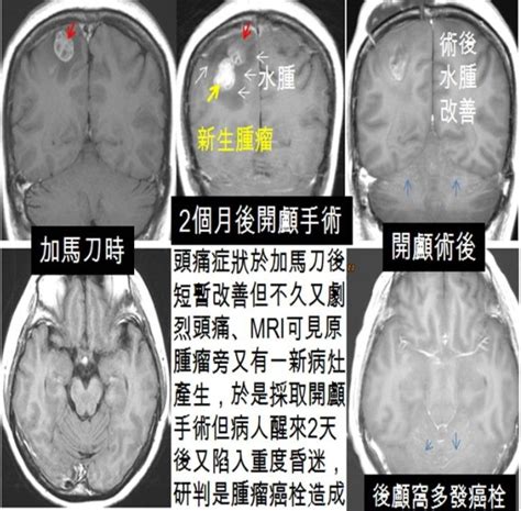 那些轉移腦瘤不適合加馬刀