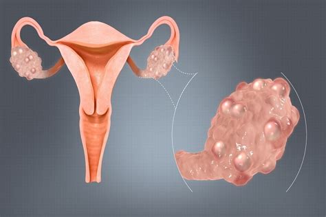 Polycystic Ovary Syndrome Pcos A Complete Guide