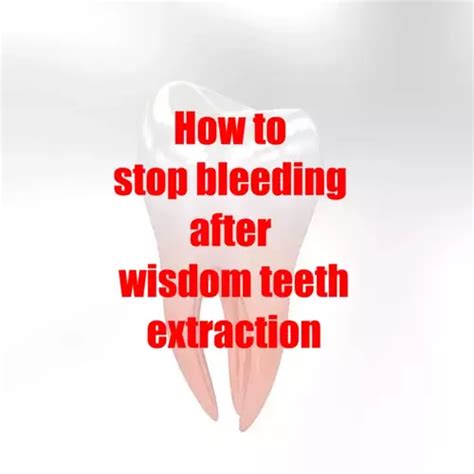 How To Stop Bleeding After Wisdom Teeth Extraction Oral Health