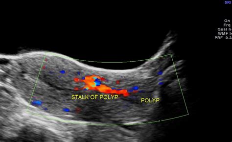 Endometrial Polyp With A Stalk Presenting In The Cervix Looking