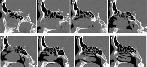 A Series Of Sagittal Ct Scans From Right To Left Showing Differences