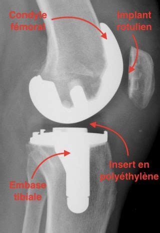 Prothèse Totale de Genou PTG Dr SIMIAN Périgueux