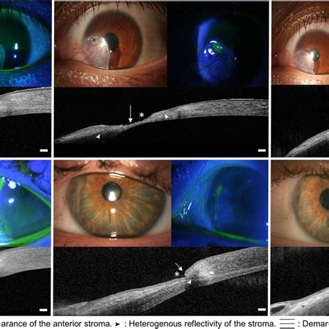 Slit Lamp Examination And As Oct In 2 Cases Of Good Outcome Under Download Scientific Diagram