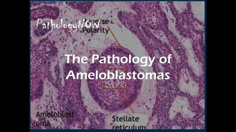 The Pathology Of Ameloblastomas YouTube