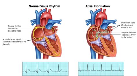 Procedure Af Ablation Melbourne Heart Group