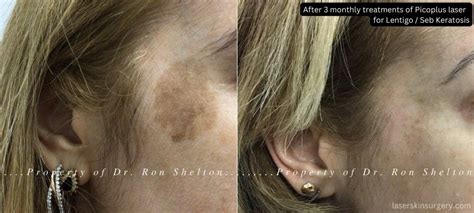 Seborreic Keratosis Removal Of Brown Spots Age Spots Ron Shelton Md