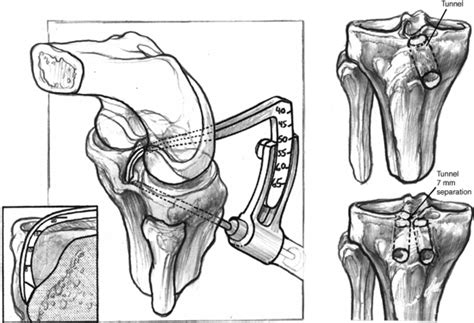 Posterior Cruciate Ligament Reconstruction All Inside Arthroscopic