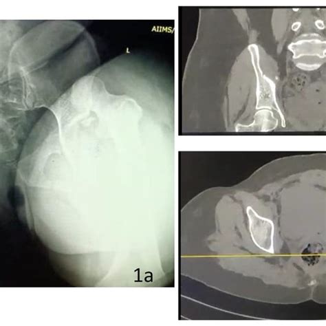 Anteroposterior Radiograph Of Both The Hips Showing A Posterior Hip Download Scientific Diagram