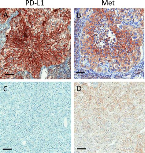 Representative Images Of Two Ccrcc Metastases Immunostained For Pd L