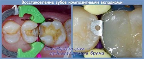 Методика восстановления зубов композитными вкладками - этапы