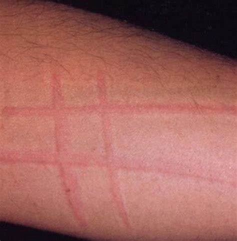 skin writing dermatographism Urticaria Dermatographia Mystery illness ...