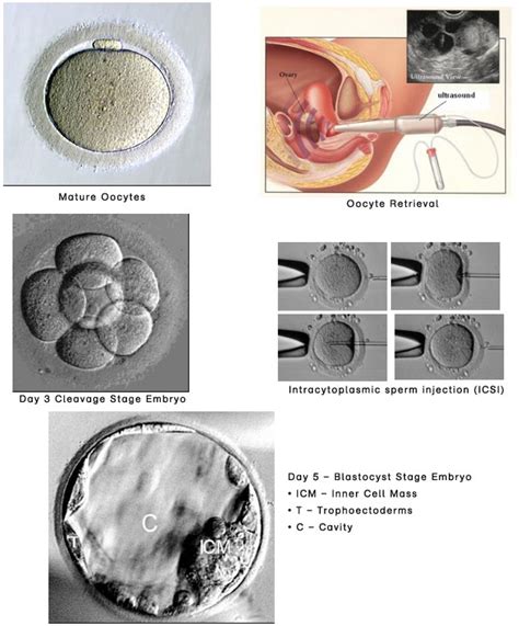 In Vitro Fertilization Ivf Icsi New York City Ivf