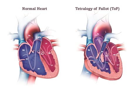 Tetralogy Of Fallot Acha