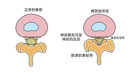 什么是腰椎管狭窄？腰椎管狭窄有哪些表现症状？ 知乎