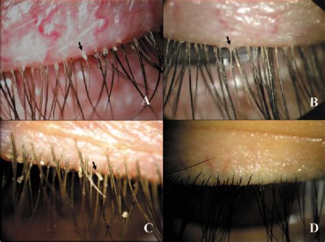 Figure 1 From High Prevalence Of Demodex In Eyelashes With Cylindrical