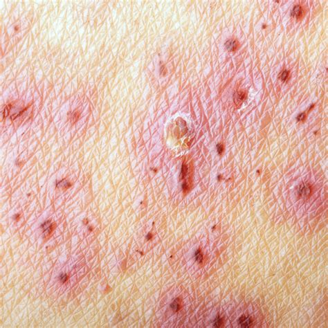 Treatment For Shingles